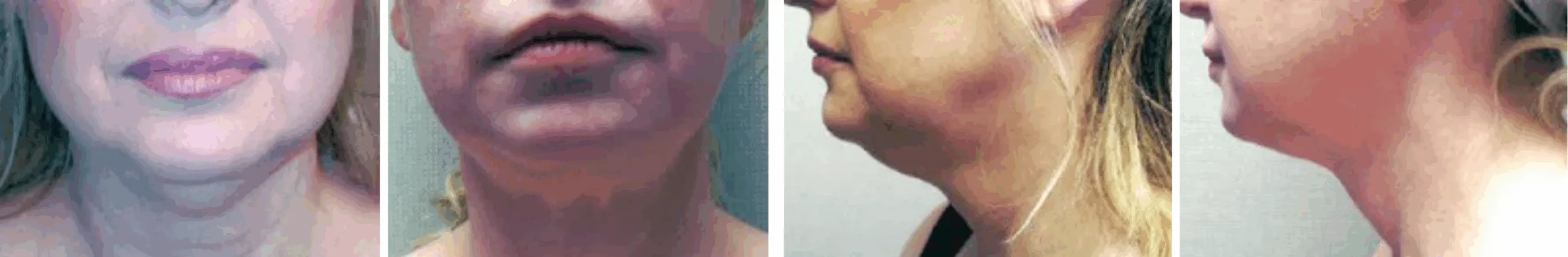 Chin Lipo In Michigan ()