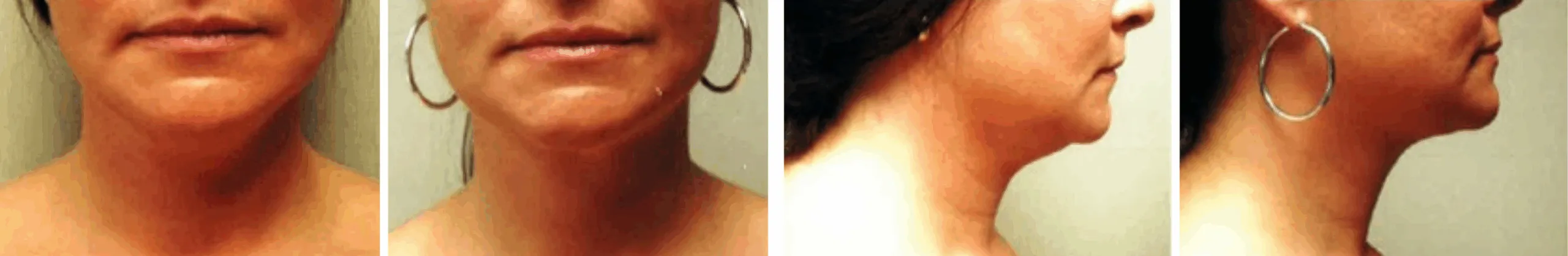 Chin Lipo In Michigan ()