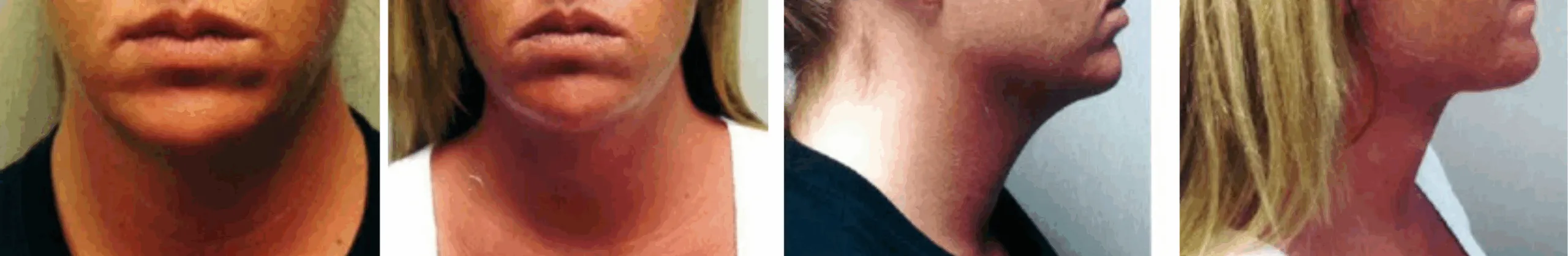 Chin Lipo In Michigan ()