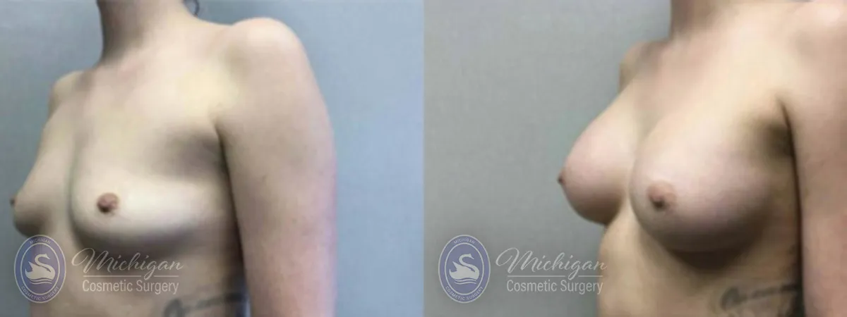 Michigan Cosmetic Surgery Southfield Breast Augmentation P