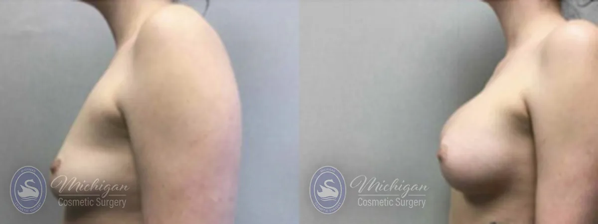Michigan Cosmetic Surgery Southfield Breast Augmentation P
