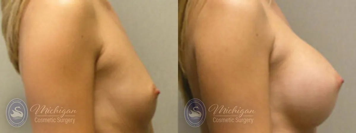 Michigan Cosmetic Surgery Southfield Breast Augmentation P