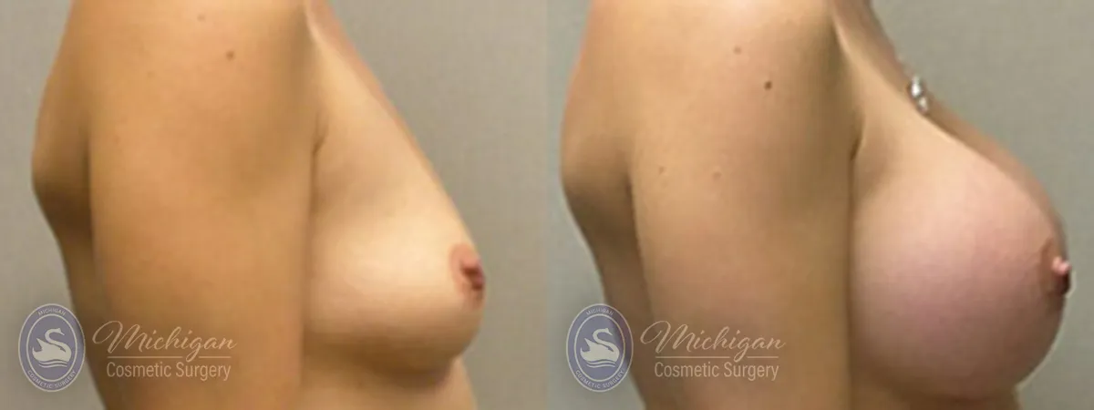 Michigan Cosmetic Surgery Southfield Breast Augmentation P