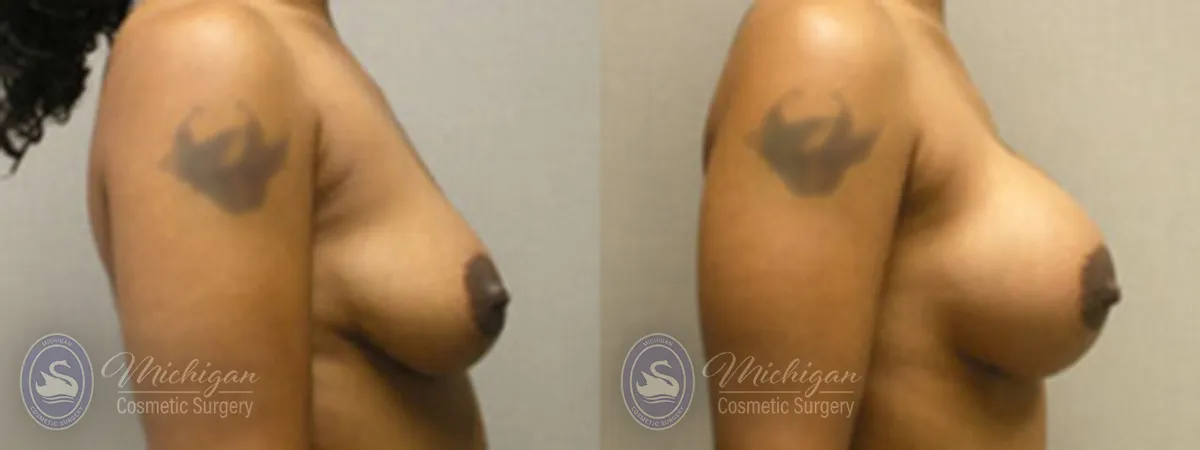Michigan Cosmetic Surgery Southfield Breast Augmentation P