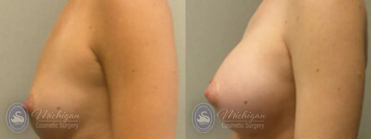 Michigan Cosmetic Surgery Southfield Breast Augmentation P