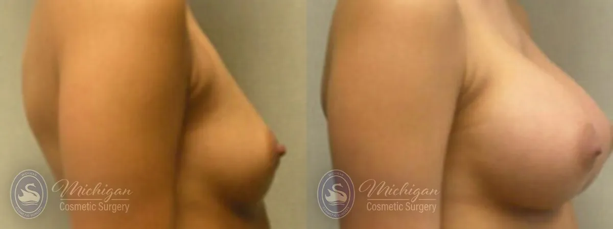 Michigan Cosmetic Surgery Southfield Breast Augmentation P