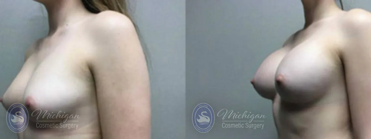 Michigan Cosmetic Surgery Southfield Breast Augmentation P