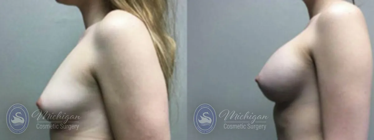 Michigan Cosmetic Surgery Southfield Breast Augmentation P