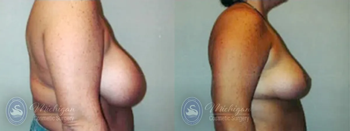 Michigan Cosmetic Surgery Southfield Breast Reduction P