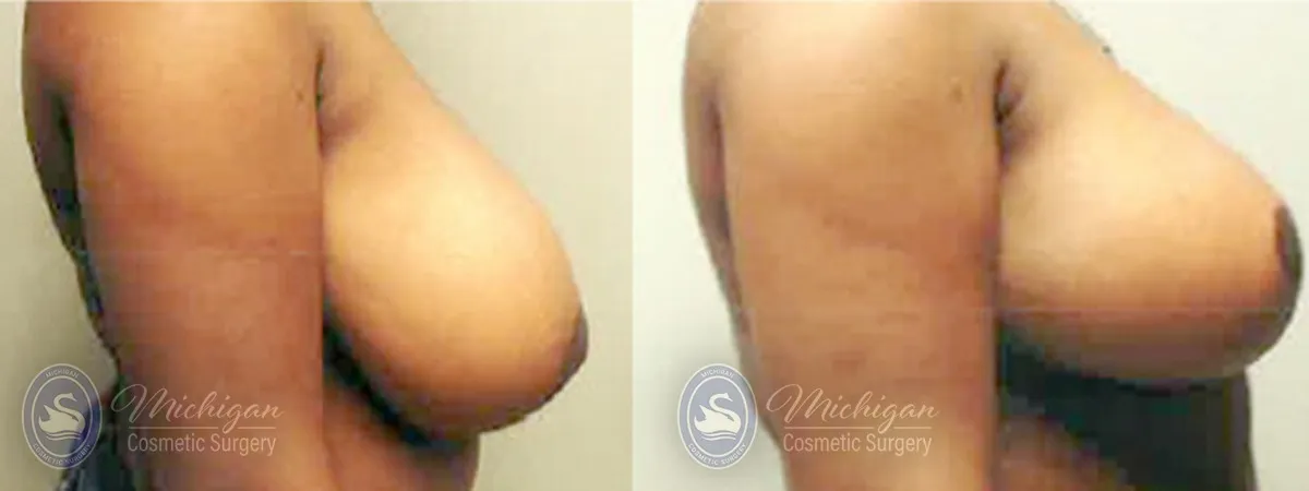 Michigan Cosmetic Surgery Southfield Breast Reduction P