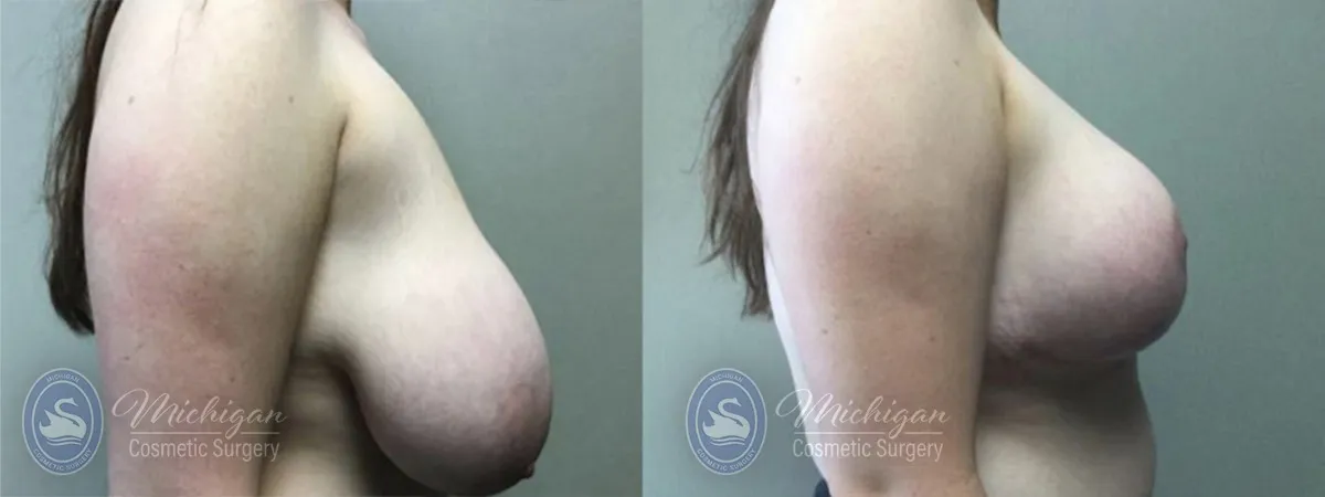 Michigan Cosmetic Surgery Southfield Breast Reduction P ()