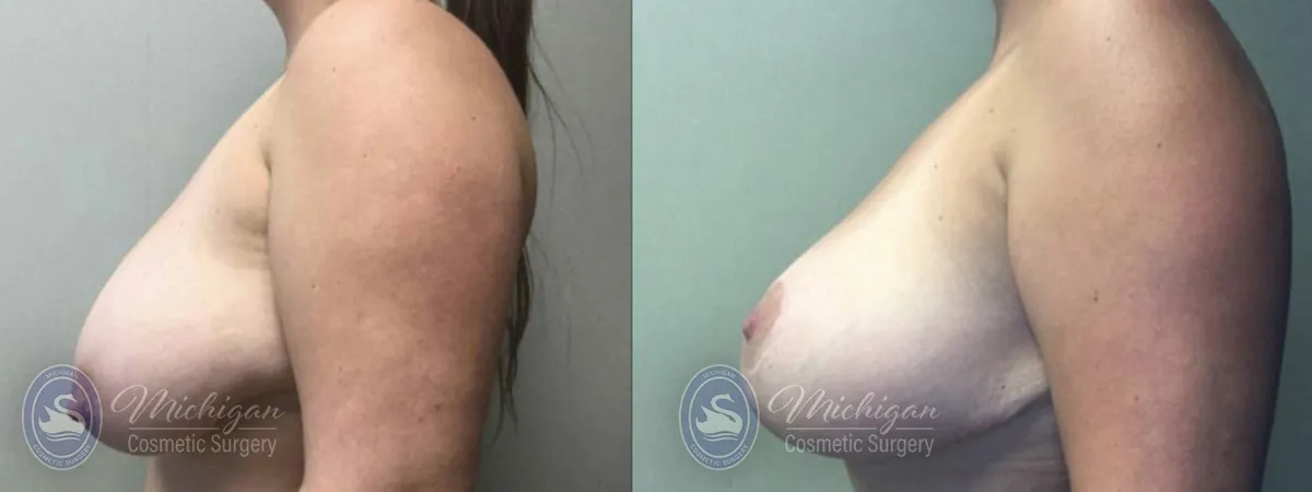 Michigan Cosmetic Surgery Southfield Breast Reduction P