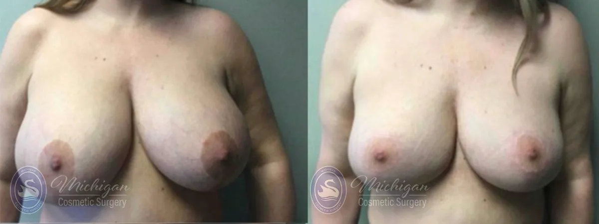 Michigan Cosmetic Surgery Southfield Breast Reduction P