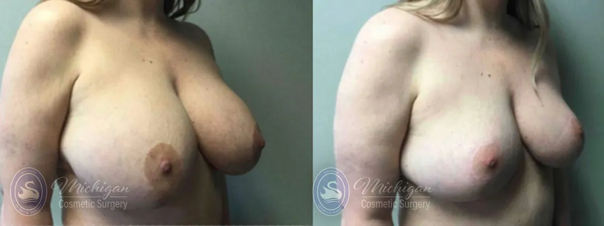 Michigan Cosmetic Surgery Southfield Breast Reduction P