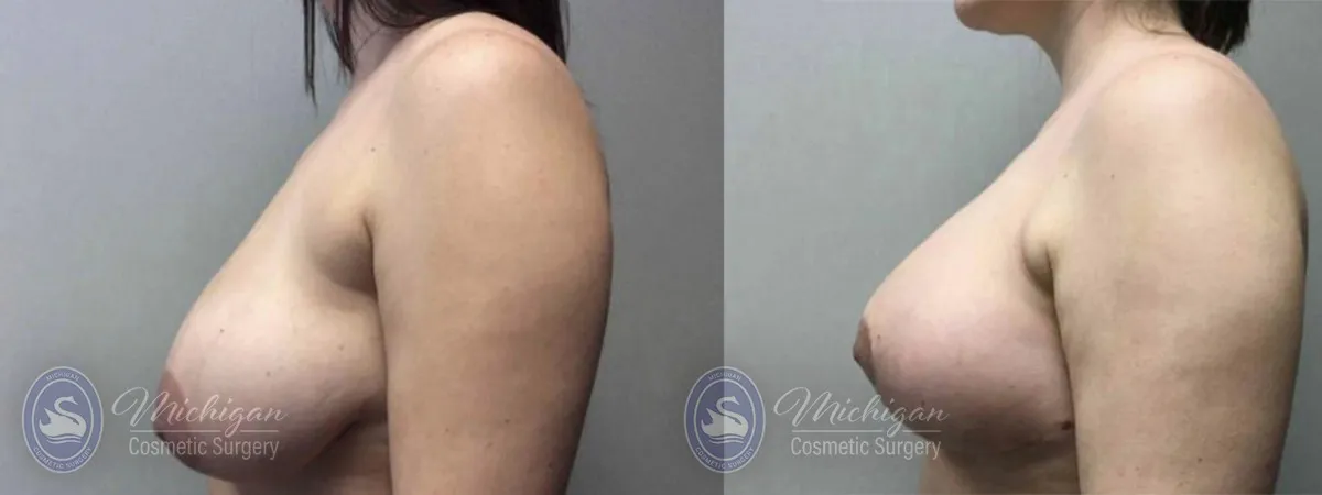 Michigan Cosmetic Surgery Southfield Breast Reduction P
