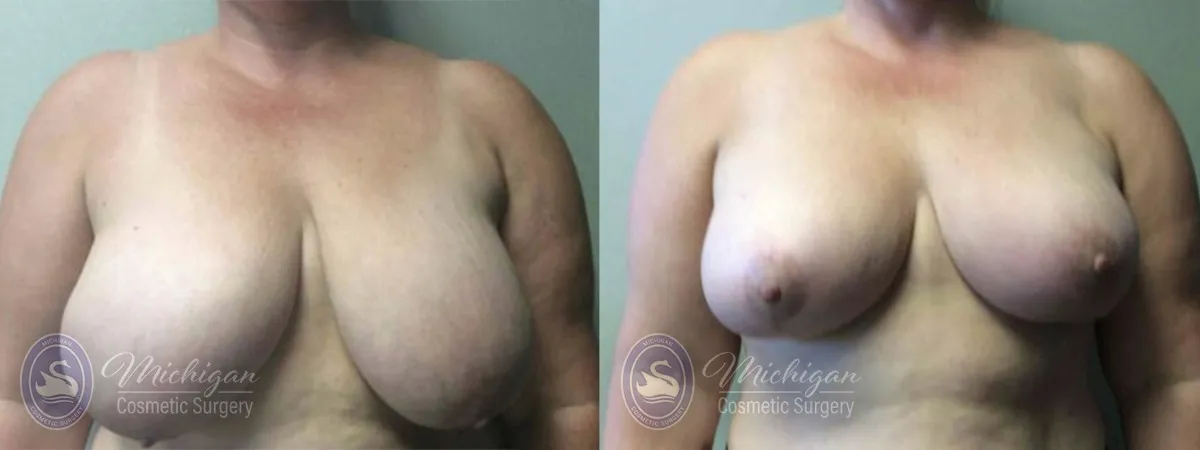 Michigan Cosmetic Surgery Southfield Breast Reduction P