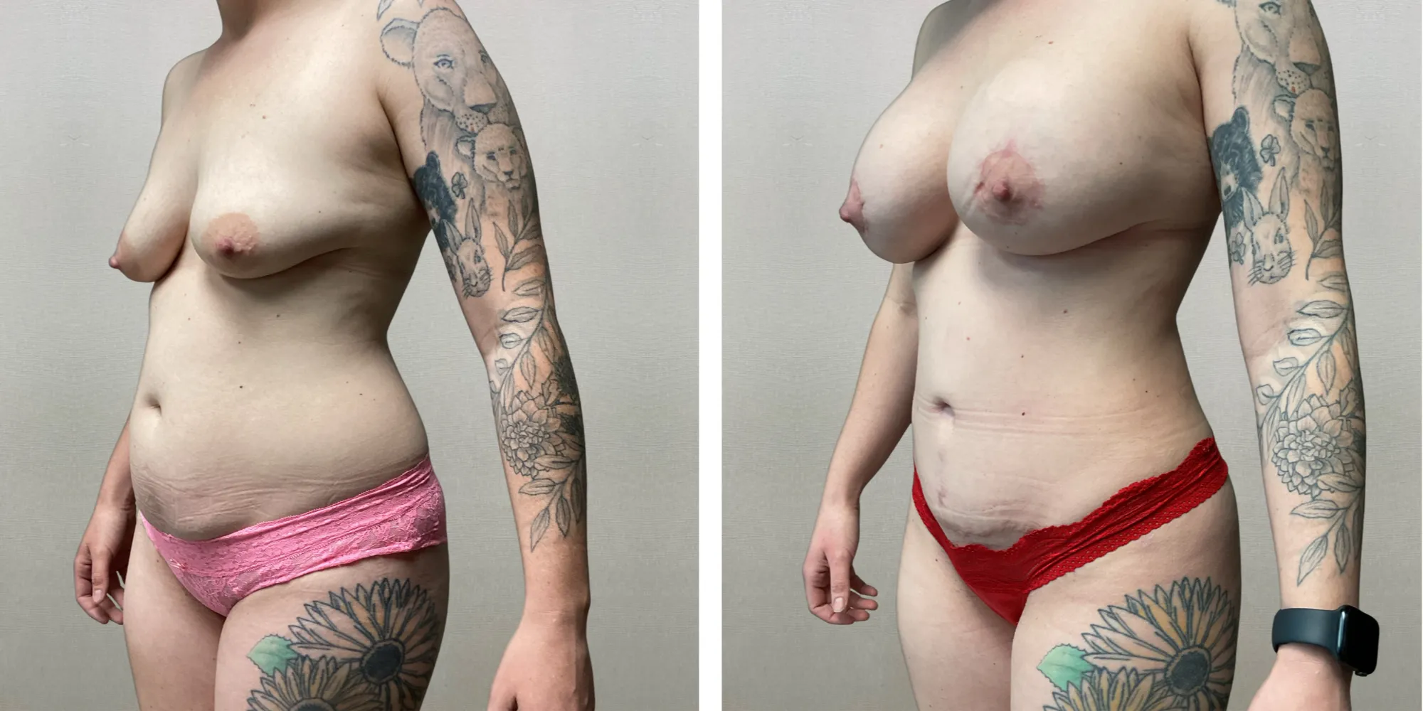 Mommy Makeover in Detroit metro ()