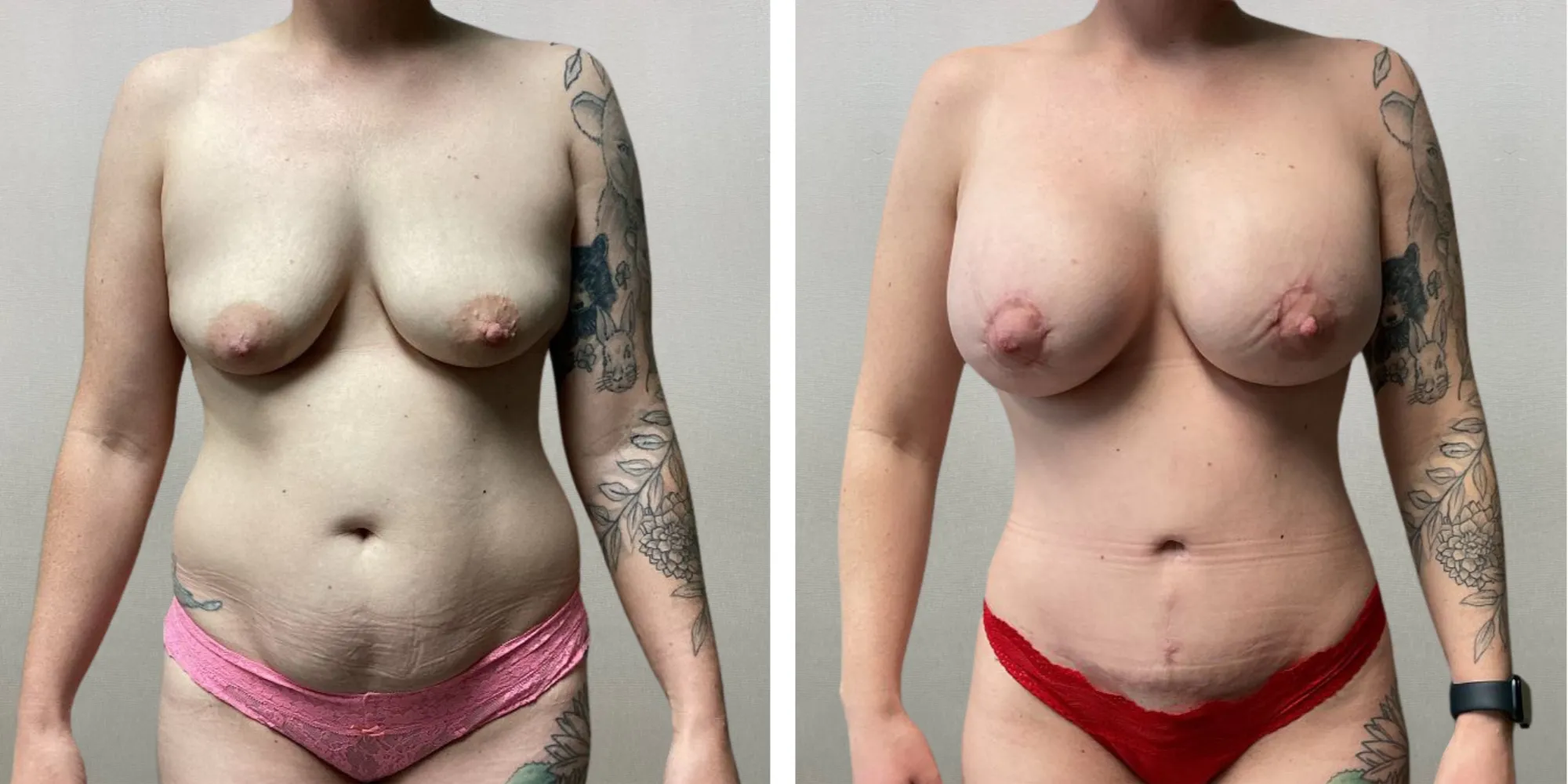 Mommy Makeover in Detroit metro