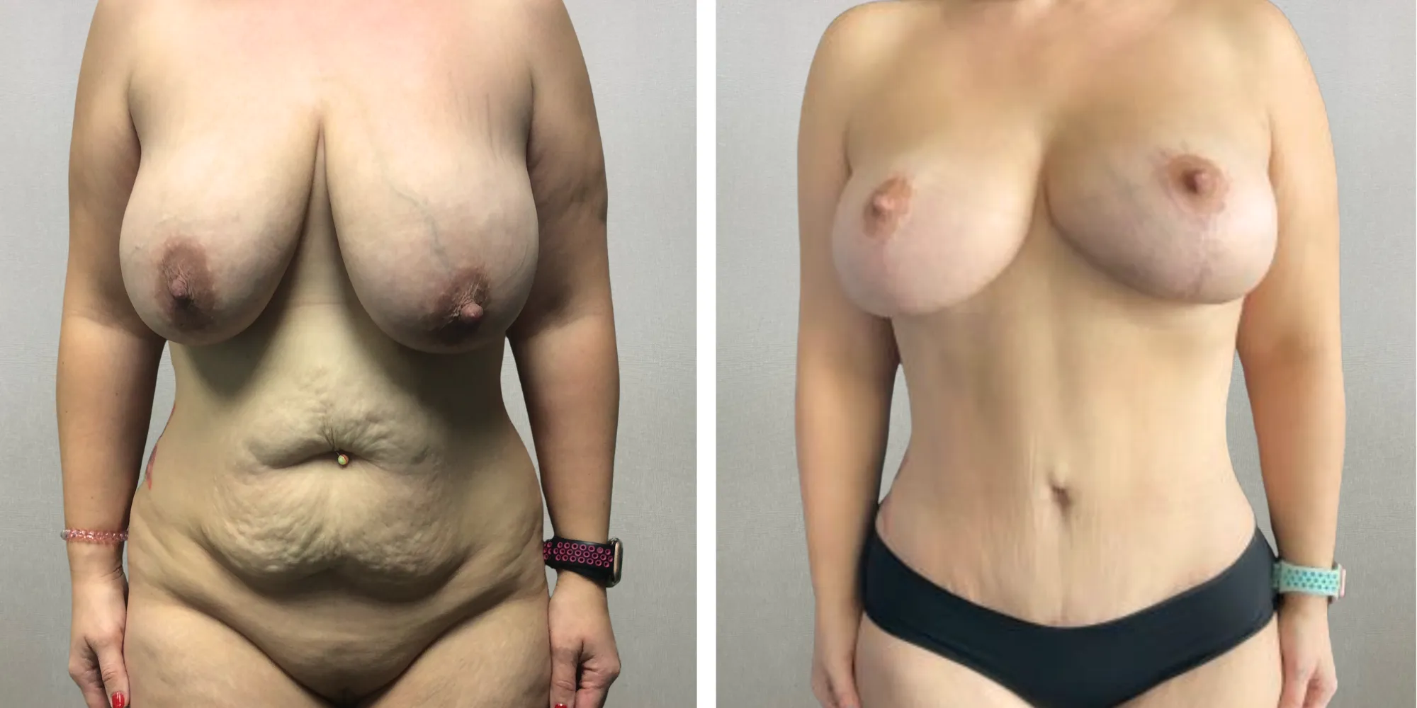 Mommy Makeover with Tummy Tuck and Lolipop in Michigan