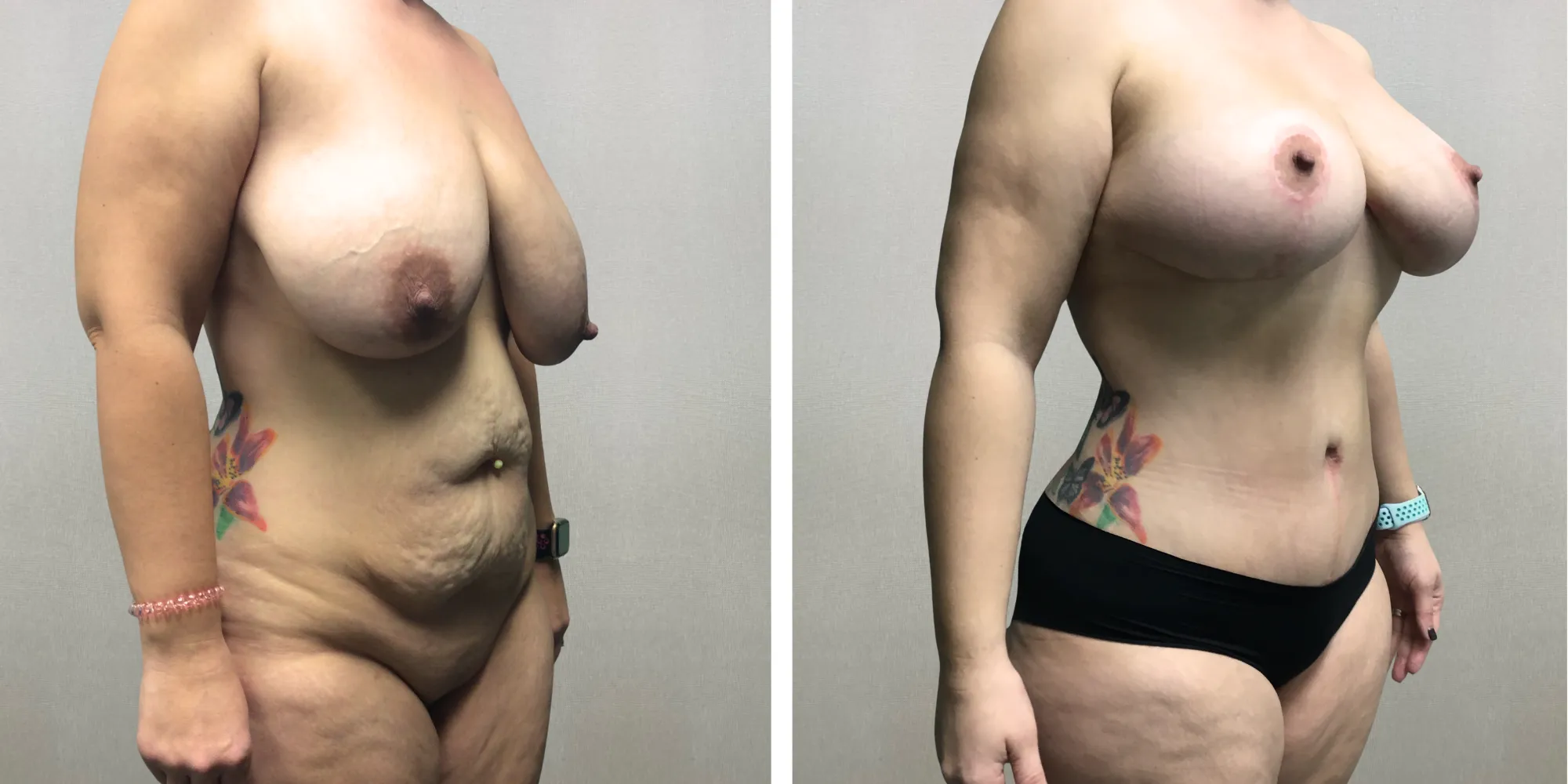 Mommy Makeover with Tummy Tuck and breast reduction