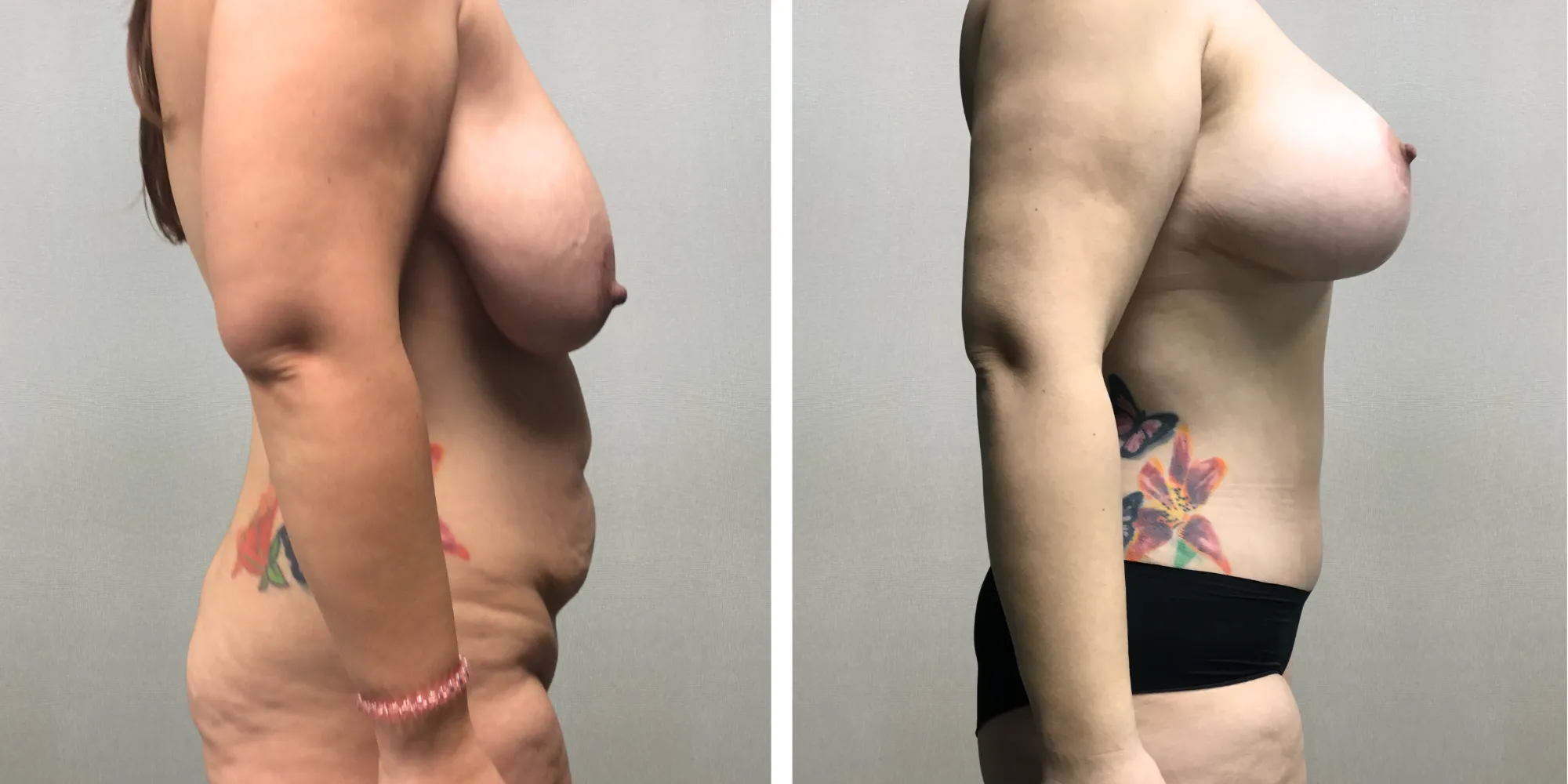 Mommy Makeover with Tummy Tuck and breast reduction