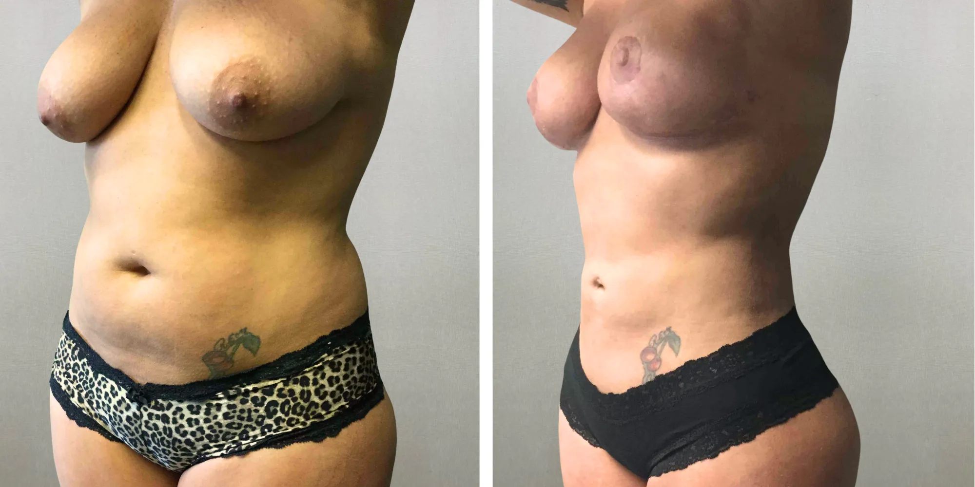 Mommy Makeover with Tummy Tuck and breast reduction in michigan ()