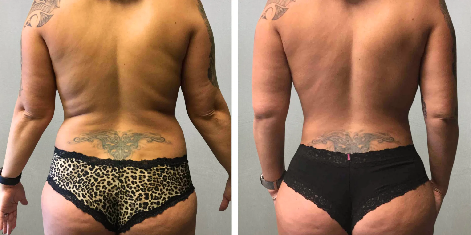 Mommy Makeover with Tummy Tuck and breast Lift in michigan