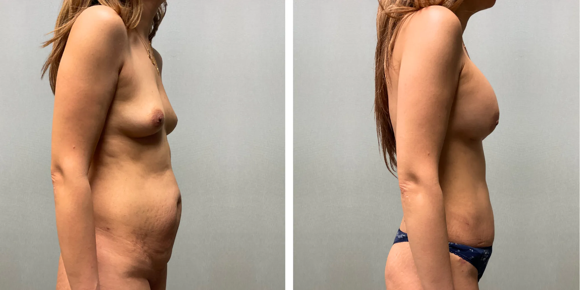 Mommy Makeover with Tummy Tuck and silicone breast augmentation in Detroirt ()