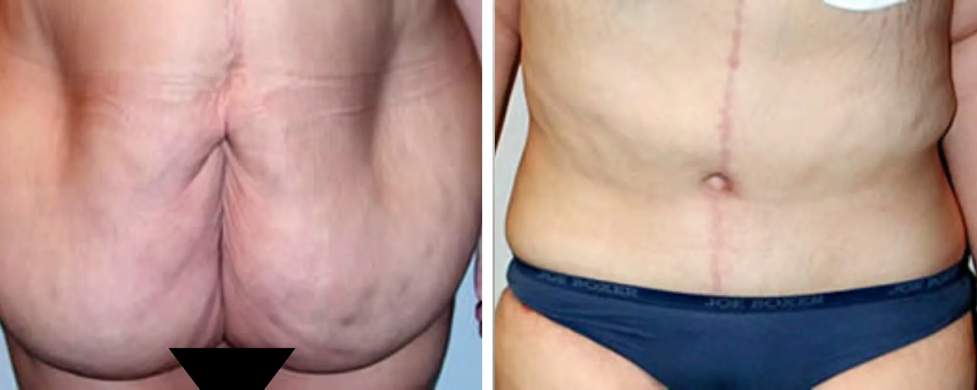 Weight Loss Makeover Body Lift in Michigan ()