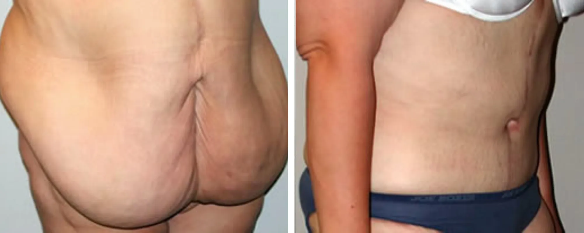 Weight Loss Makeover Body Lift in Michigan ()