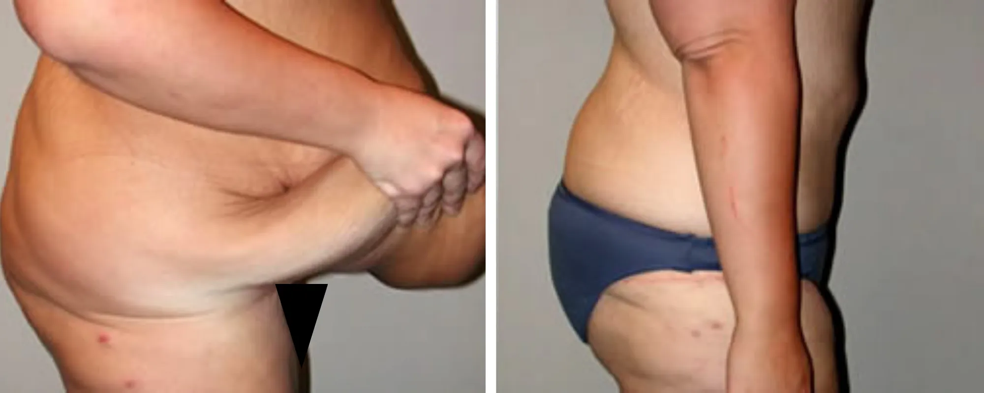 Weight Loss Makeover Body Lift in Michigan ()