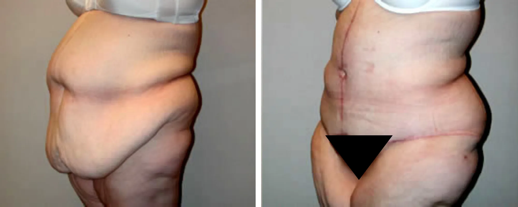 Weight Loss Makeover Body Lift in Michigan ()