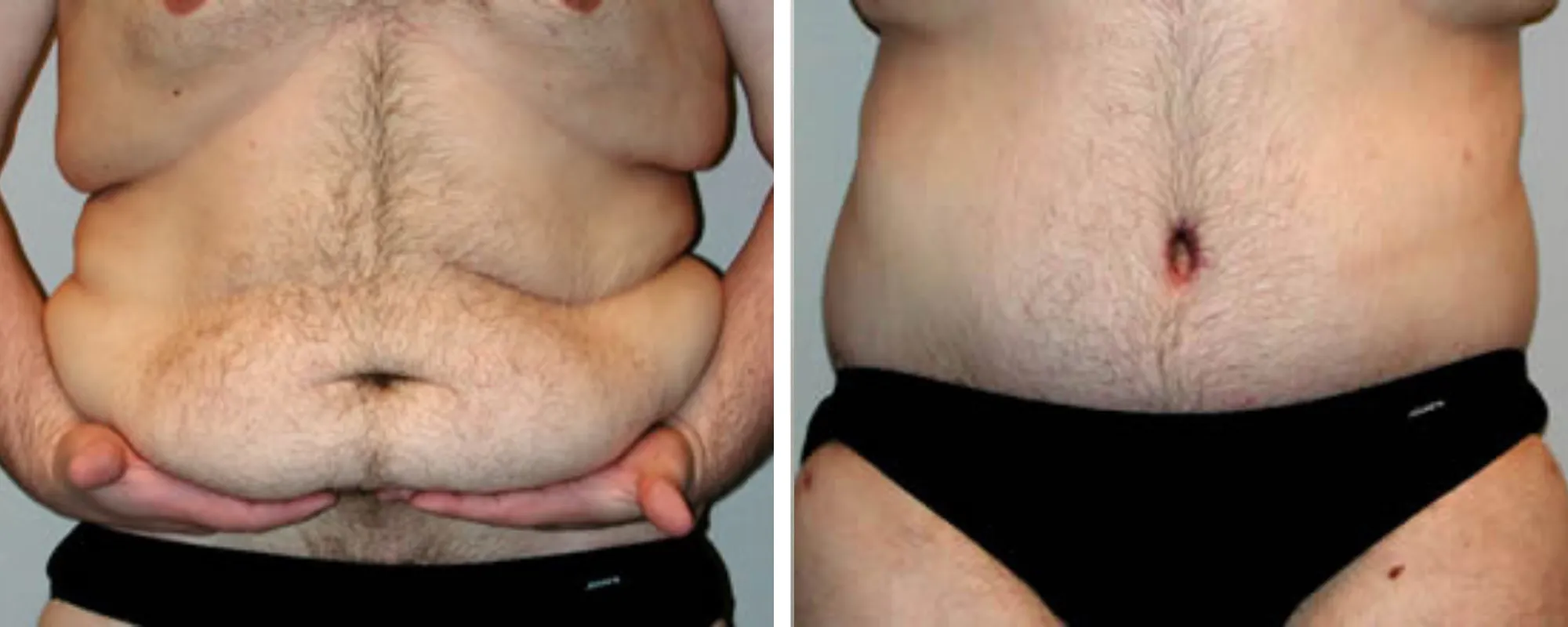 Weight Loss Makeover Body Lift in Michigan ()