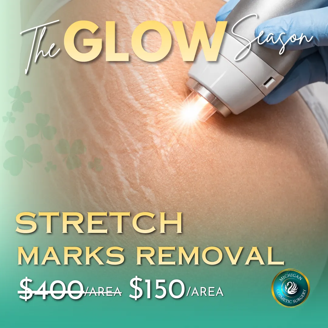 Stretch Marks Removal in Michigan
